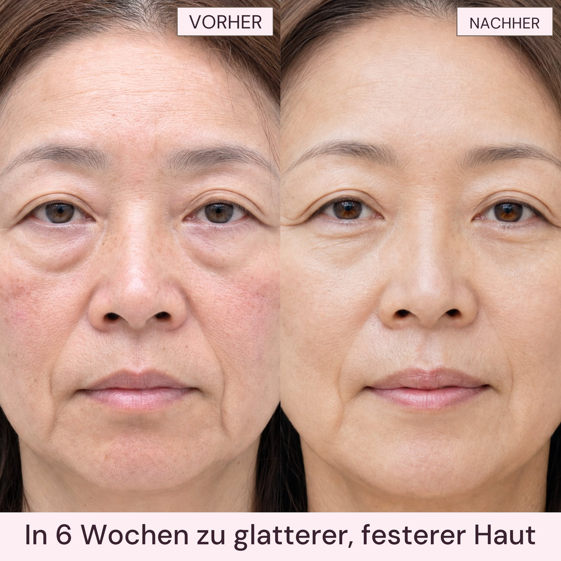 Vorher und nachher: glattere, festere Haut nach 6 Wochen