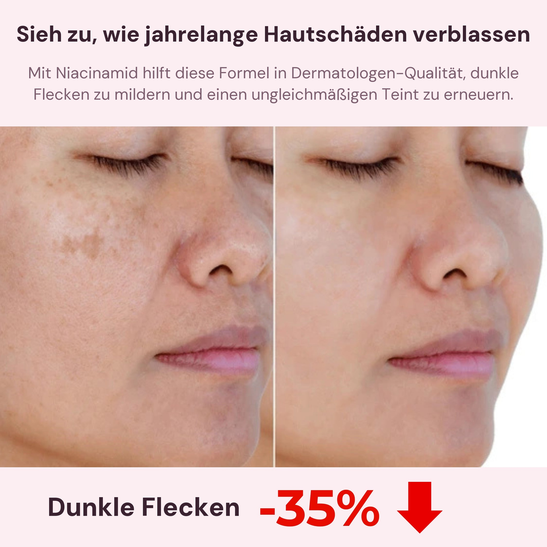 Dunkle Flecken vorher und nachher: -35%